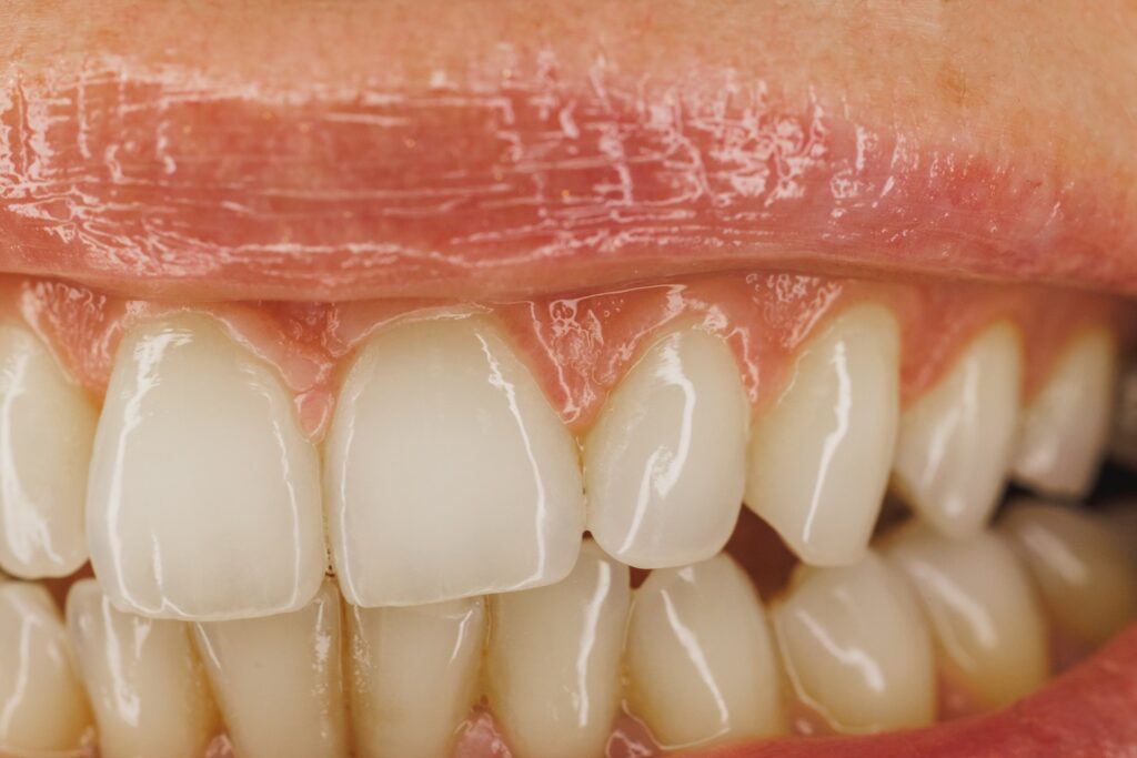 Natural Teeth Remineralization