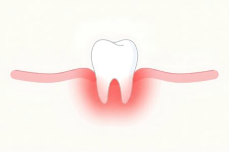 Receding_Gums
