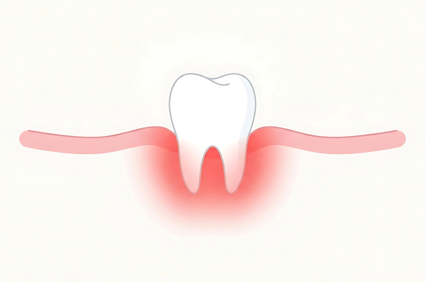 Receding_Gums
